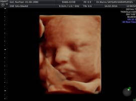 Four D (4D) Ultrasound 8