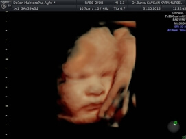 Four D (4D) Ultrasound 1