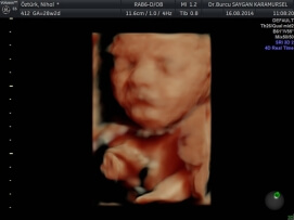 Four D (4D) Ultrasound 2