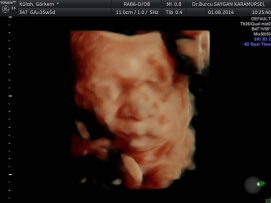 Four D (4D) Ultrasound 3