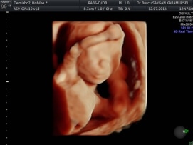 Four D (4D) Ultrasound 4