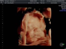 Four D (4D) Ultrasound 5