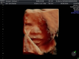 Four D (4D) Ultrasound 7