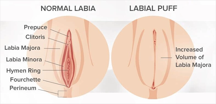 Genital Dolgu Labial Puff