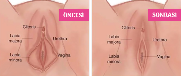 Labioplasti Ameliyatı Öncesi - Sonrası