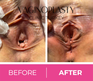 Hymenoplasty Post Op