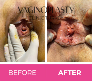 Hymenoplasty Post Op