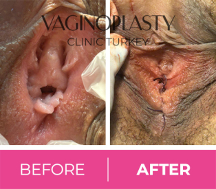 Post Op Hymenoplasty